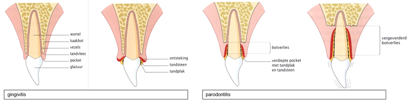 Gingivitis.png